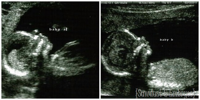 The twins at 14 weeks {Sawdust and Embryos}